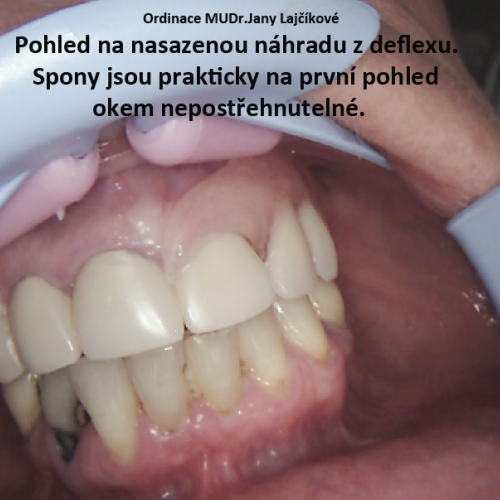 12-18 Bezkovová snímatelná náhrada z Deflexu.png
