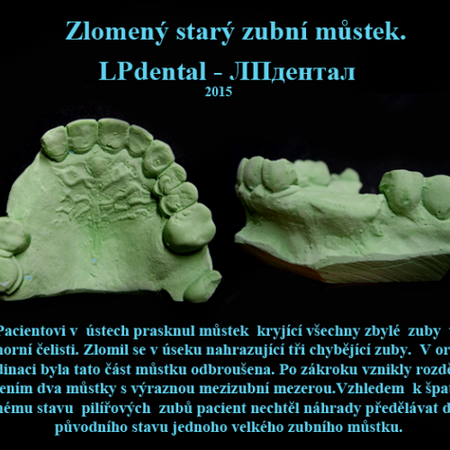 03-14 Bezkovová snímatelná náhrada z Deflexu.png.png
