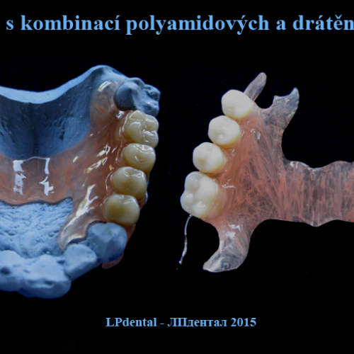 3-3  Drátěná spona-Snímatelné náhrady z Deflexu kombinace polyamid-kov..png