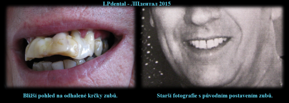 2 Paradentóza-zhotovení protézy podle starší fotografie s původním postavením zubů..png