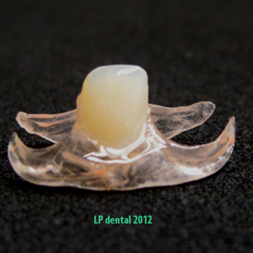 9 LP dental- bezkovová snímatelná náhrada-Deflex.png