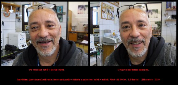 3 Imediátní (provizorní)náhrada zhotovená podle vzhledu a postavení zubů v mládí. Muž věk 50 let..jp