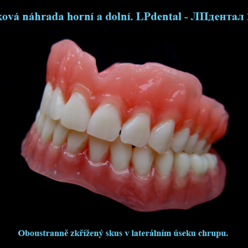 22 Oboustranně zkřížený skus v laterálním úseku chrupu..png