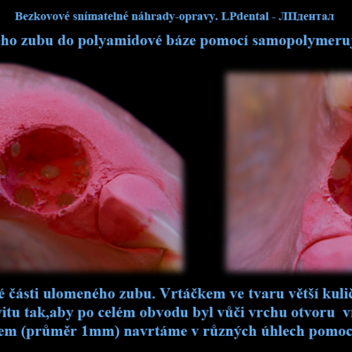 2 Dodání zlomeného zubu do polyamidové báze pomocí samopolymerující pryskyřice..png