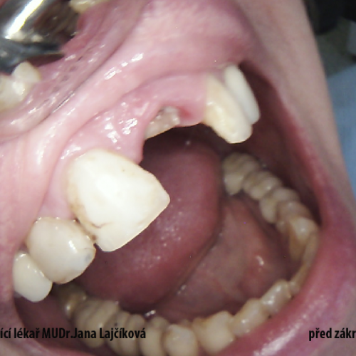 1 MUDr.Jana Lajčíková-Petr Moj- LPdental-keramika NORITAKE ノリタケ.png