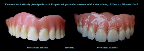 6 Porovnání původní a nové zubní náhrady..png