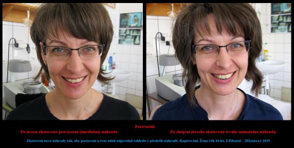 5 Zhotovení kopie náhrady,která byla  vyrobena podle vzhledu úsměvu před úrazem..jpg