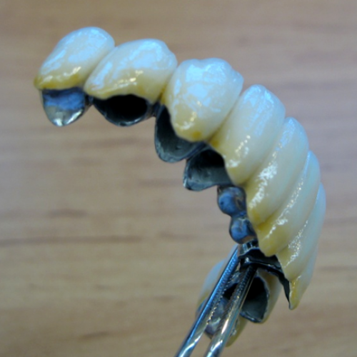 5  LP dental-keramický můstek-keramika NORITAKE ノリタケ.png