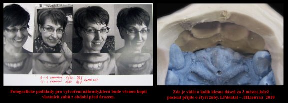 2 fotografické podklady-úbytek dásně po ztrátě zubů..jpg