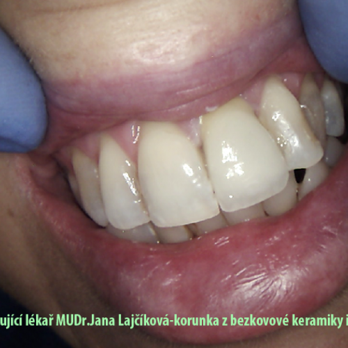 7 Korunka plášťová keramická.png
