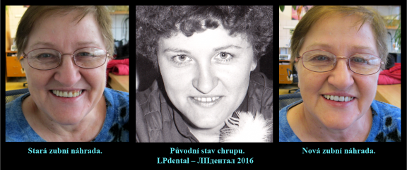 3 Porovnání výsledku se starou zubní náhradou a fotografickou předlohou..png