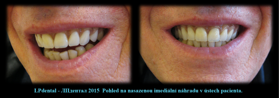 5 Paradentóza-zhotovení protézy podle starší fotografie s původním postavením zubů..png