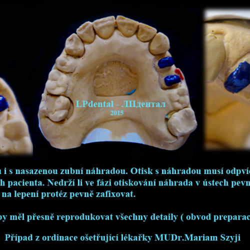 31 Nahrazení pilířového zubu celolitou korunkou..png