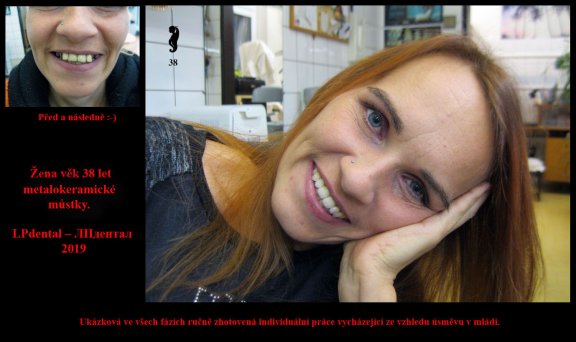 Žena věk 38 let metalokeramické můstky..jpg