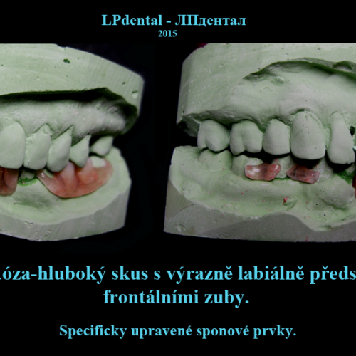 04-5 Bezkovová snímatelná náhrada z Deflexu.png