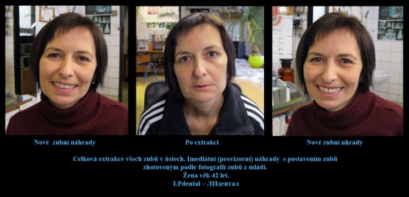 Celková extrakce všech zubů v ústech. Imediátní (provizorní) náhrady  s postavením zubů zhotoveným p