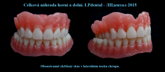 Oboustranně zkřížený skus v laterálním úseku chrupu..png