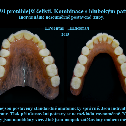 18-33 Bezkovová snímatelná náhrada z Deflexu..png