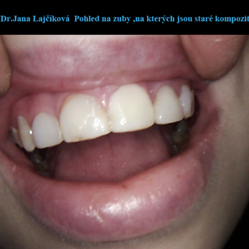 18 Korunky a fasety z kompozitního plastu.png