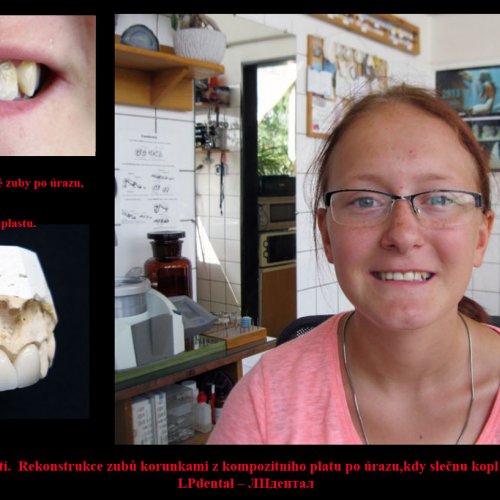 Kompozitní korunky-rekonstrukce zubů po úrazu..jpg