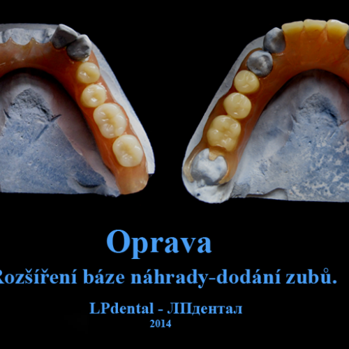 34 Rozšíření báze a dodání zubů s pomocí polyamidu.