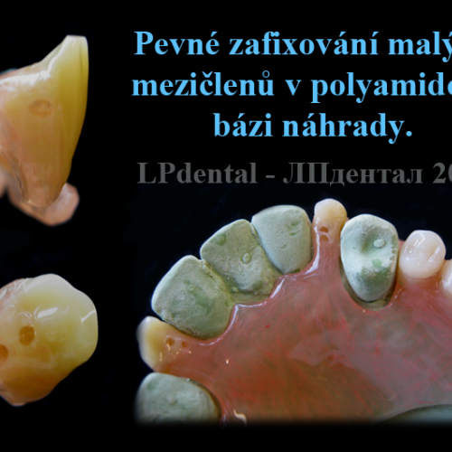 11-21 Bezkovová snímatelná náhrada z Deflexu.png
