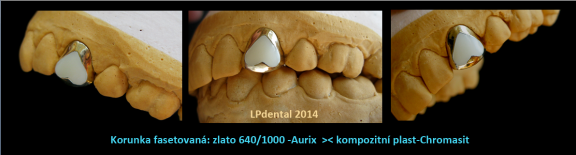 7 Korunka fasetovaná-LPdental.png