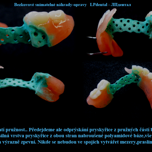 13 Dodání zubu a rozšíření báze pomocí samopolymerující pryskyřice..png