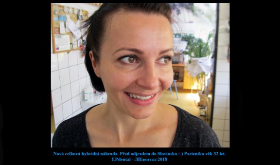 Horní celková hybridní náhrada-fixace systém Locator- nová náhrada přrd odjezdem domů 27.jpg