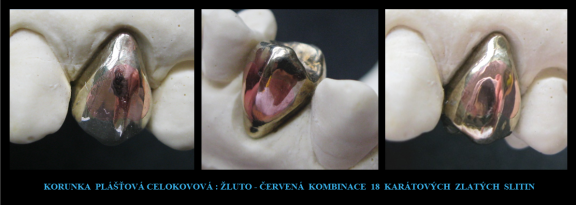 6 Korunka plášťová-celokovová-zlato 18 karátů-LPdental.png