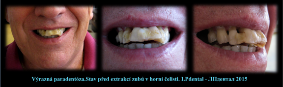 1 Paradentóza-zhotovení protézy podle starší fotografie s původním postavením zubů..png