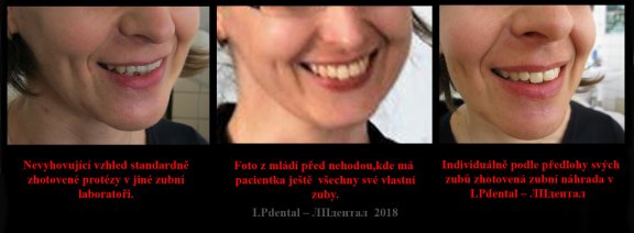 9 porovnání esteticky nevyhovující náhrada-foto z mládí-nové zuby..jpg