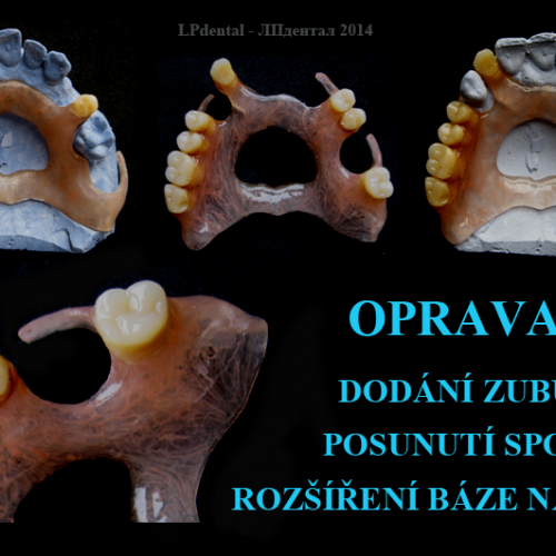 33 Rozšíření báze-dodání zubů a spony -s pomocí polyamidu.