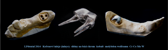 3 Inlej-Inlay chrom-kobalt-molybden-wolfram.png