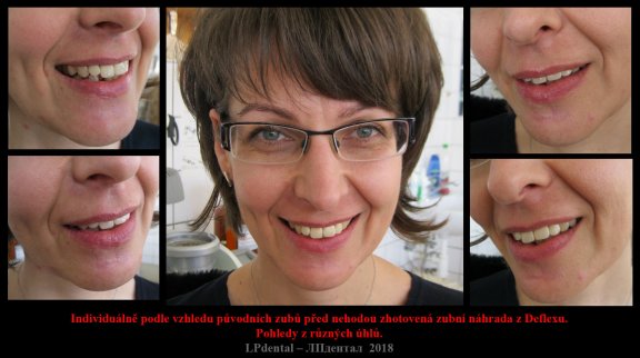 12 individuálně zhotovená náhrada v detailech..jpg