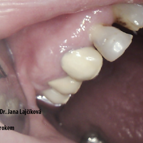13  MUDr.Jana Lajčíková-Petr Moj- LPdental-keramika NORITAKE ノリタケ.png