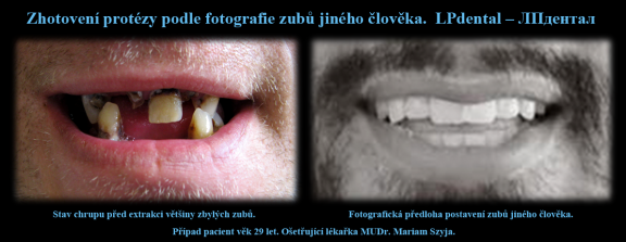 1 Pacient věk 29 let. Původní stav chrupu a použitá fotografická předloha ,která bude vzorem pro nov