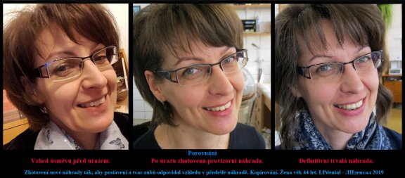  1 Zhotovení kopie náhrady,která byla  vyrobena podle vzhledu úsměvu před úrazem..jpg
