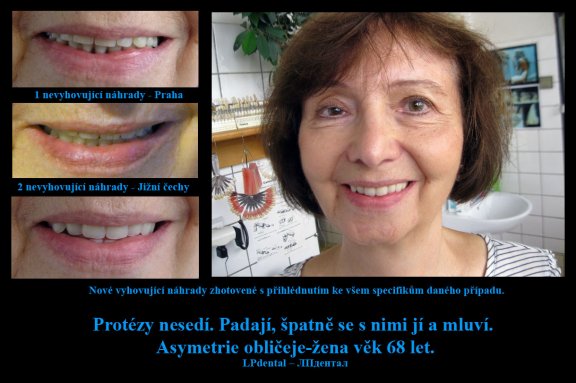 0 Protézy nesedí. Padají, špatně se s nimi jí a mluví. Asymetrie obličeje.jpg