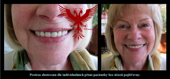 Protézy zhotovené dle individuálních přání pacientky bez účasti pojišťovny..png