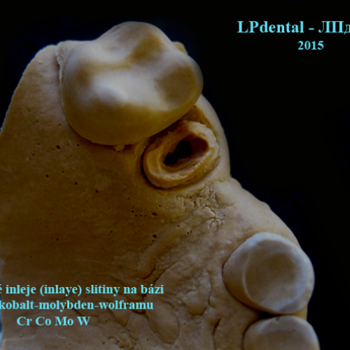 08 inlay kořenová 2 kanálky-nepřímá litá.png