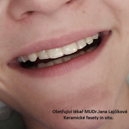 2 Estetická faseta keramická.png