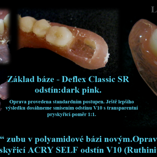 22 Nahrazení ujetého zubu v polyamidové bázi novým pomocí samopolymerující pryskyřice..png