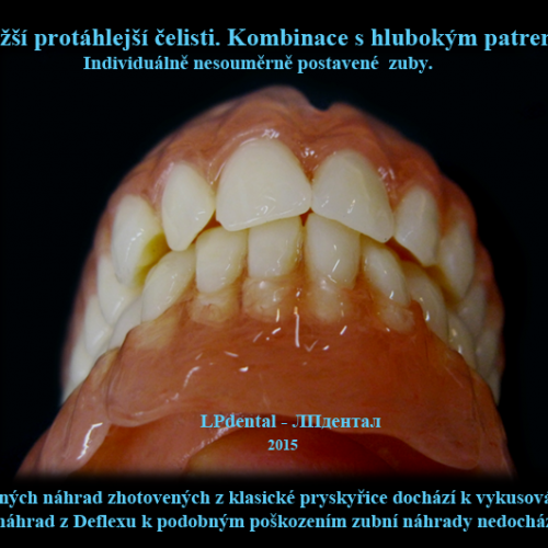 18-34 Bezkovová snímatelná náhrada z Deflexu..png