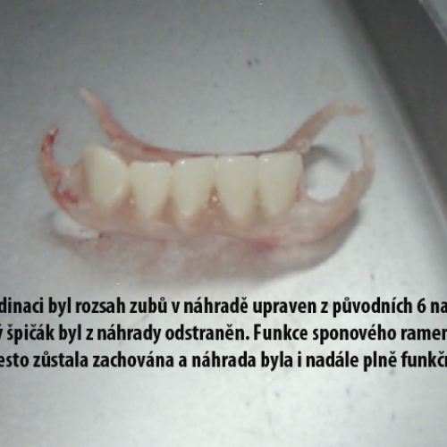 06-5 Bezkovová snímatelná náhrada z Deflexu..png