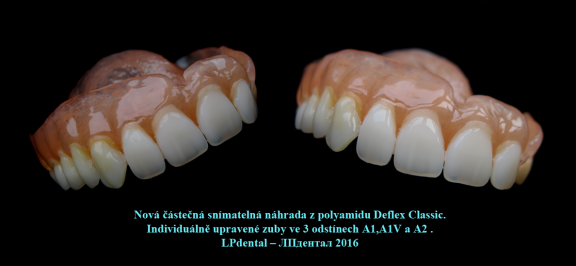 6 Nová částečná snímatelná náhrada z polyamidu Deflex Classic..png