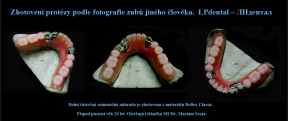6 Dolní částečná náhrada z Deflexu Classic s litou výztuží..png