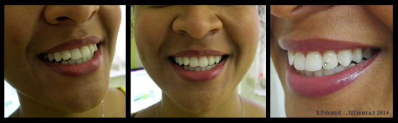 1-2 Teeth Jewelry.png