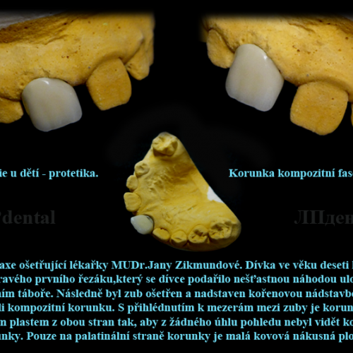 01 Stomatologie u dětí-korunka kompozitní fasetovaná-ATR..png