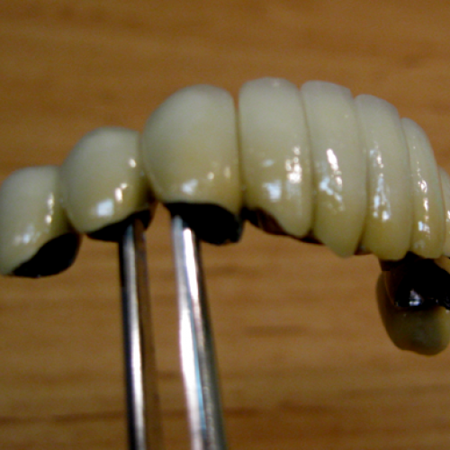 6  LP dental-keramický můstek-keramika NORITAKE ノリタケ.png